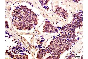 Formalin-fixed and paraffin embedded human lung carcinoma with labeled Anti-Cytomegalovirus pp65 Polyclonal Antibody, Unconjugated (ABIN738276) at 1:200, followed by conjugation to the secondary antibody and DAB staining (STAT5A anticorps  (AA 61-160))