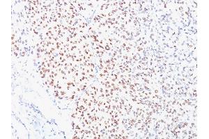 Formalin-fixed, paraffin-embedded human Melanoma stained with MITF Mouse Monoclonal Antibody (D5). (MITF anticorps)