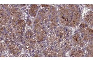 ABIN6273981 at 1/100 staining Human liver cancer tissue by IHC-P. (OR2S2 anticorps  (C-Term))