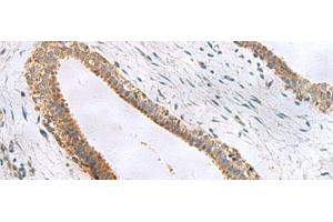 Immunohistochemistry of paraffin-embedded Human breast cancer tissue using CEMIP Polyclonal Antibody at dilution of 1:120(x200) (CEMIP anticorps)