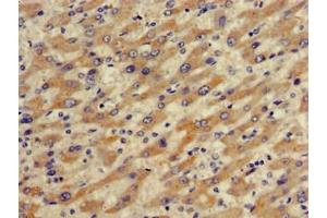 Immunohistochemistry of paraffin-embedded human liver cancer using ABIN7170287 at dilution of 1:100 (SLCO1B1 anticorps  (AA 426-537))