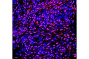 Immunofluorescence of paraffin embedded human cervical cancer using PABPN1 (ABIN7075116) at dilution of 1:600 (400x lens) (PABPN1 anticorps)