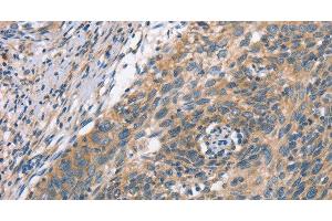 Immunohistochemistry of paraffin-embedded Human cervical cancer using PLEKHO1 Polyclonal Antibody at dilution of 1:70 (PLEKHO1 anticorps)