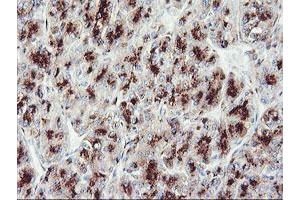 Immunohistochemical staining of paraffin-embedded Carcinoma of Human liver tissue using anti-GOLM1 mouse monoclonal antibody. (GOLM1 anticorps)