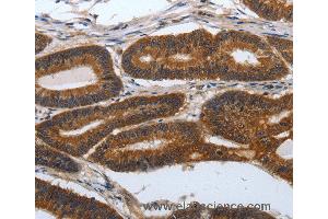 Immunohistochemistry of Human lung cancer using PDCD7 Polyclonal Antibody at dilution of 1:60 (PDCD7 anticorps)