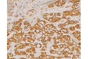 Immunohistochemistry analysis of liver Cancer using GOT2 Antibody at a dilution of (1/100 200x).