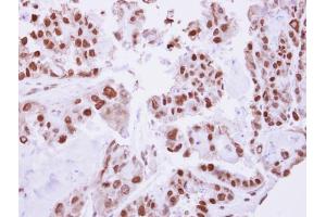 IHC-P Image Immunohistochemical analysis of paraffin-embedded human ovarian cancer, using C/EBP beta, antibody at 1:250 dilution. (CEBPB anticorps  (N-Term))