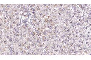 ABIN6276810 at 1/100 staining Human melanoma tissue by IHC-P. (PEDF anticorps  (C-Term))