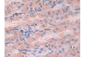 Detection of STC1 in Human Stomach cancer Tissue using Polyclonal Antibody to Stanniocalcin 1 (STC1)