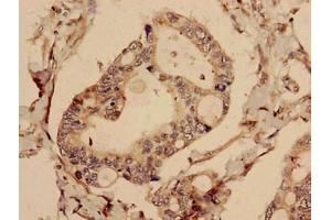 Immunohistochemistry analysis of human pancreatic cancer using ABIN7147768 at dilution of 1:100 (CFAP61 anticorps  (AA 1-200))