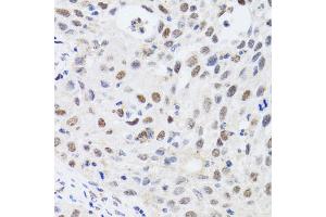 Immunohistochemistry of paraffin-embedded human lung cancer using CBX4 antibody. (CBX4 anticorps)