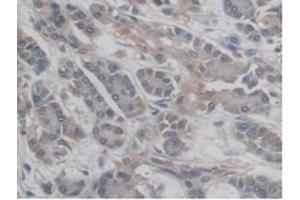IHC-P analysis of Human Pancreas Cancer Tissue, with DAB staining. (DC-SIGN/CD209 anticorps  (AA 70-404))