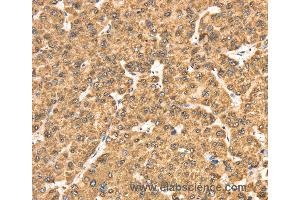 Immunohistochemistry of Human liver cancer using RRBP1 Polyclonal Antibody at dilution of 1:25 (RRBP1 anticorps)
