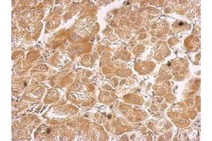 IHC-P Image HHIP antibody [N3C2], Internal detects HHIP protein at cytosol on human hepatoma by immunohistochemical analysis. (HHIP anticorps)