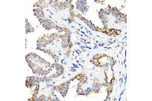 Immunohistochemistry of paraffin-embedded human thyroid cancer using TST Rabbit pAb  at dilution of 1:200 (40x lens).