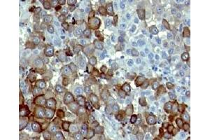 Formalin-fixed, paraffin-embedded human melanoma stained with NGFR antibody (NTR/912). (NGFR anticorps)
