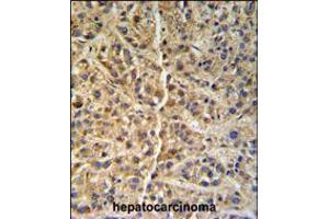 GNS Antibody (Center S298) IHC analysis in formalin fixed and paraffin embedded human hepatocarcinoma followed by peroxidase conjugation of the secondary antibody and DAB staining. (GNS anticorps  (AA 283-313))