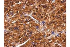 IHC-P Image Immunohistochemical analysis of paraffin-embedded human hepatoma, using BIVM, antibody at 1:500 dilution. (BIVM anticorps  (C-Term))