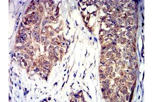 Immunohistochemical analysis of paraffin-embedded bladder cancer tissues using CD100 mouse mAb with DAB staining.
