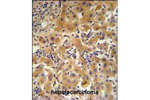 CP Antibody IHC analysis in formalin fixed and paraffin embedded human hepatocarcinoma followed by peroxidase conjugation of the secondary antibody and DAB staining.