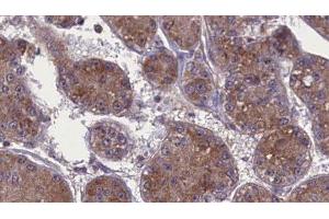 ABIN6277718 at 1/100 staining Human liver cancer tissue by IHC-P.
