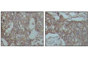 Immunohistochemical analysis of paraffin-embedded human breast carcinoma tissues, showing membrane localization with DAB staining using CD44 mouse mAb. (CD44 anticorps)