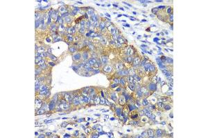 Immunohistochemistry of paraffin-embedded human gastric cancer using ARFGAP1 antibody at dilution of 1:100 (x40 lens). (ARFGAP1 anticorps)