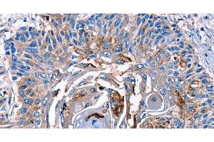Immunohistochemistry of paraffin-embedded Human esophagus cancer tissue using LRP2 Polyclonal Antibody at dilution 1:40 (LRP2 anticorps)