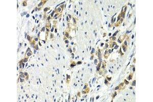 Immunohistochemistry of paraffin-embedded Human gastric cancer using WNT3A Polyclonal Antibody at dilution of 1:200 (40x lens). (WNT3A anticorps)