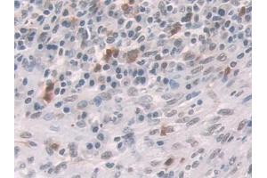 DAB staining on IHC-P; Samples: Human Colorectal cancer Tissue