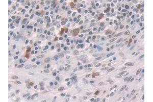 DAB staining on IHC-P; Samples: Human Colorectal cancer Tissue (Glucocorticoid Receptor anticorps  (AA 532-730))