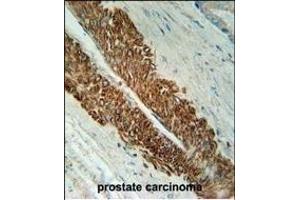 STE Antibody (Center) (ABIN651772 and ABIN2840394) immunohistochemistry analysis in formalin fixed and paraffin embedded human prostate carcinoma followed by peroxidase conjugation of the secondary antibody and DAB staining.