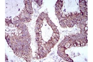 Immunohistochemical analysis of paraffin-embedded colon cancer tissues using SNAI2 mouse mAb with DAB staining. (SLUG anticorps  (AA 100-200))