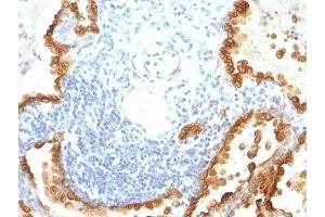 Formalin-fixed, paraffin-embedded human lung carcinoma stained with Cytokeratin 8 + 18 antibody (KRT8/803 + KRT18/835). (Cytokeratin 8/18 anticorps)
