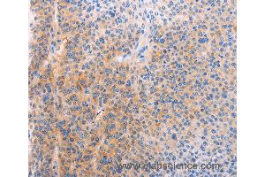 Immunohistochemistry of Human cervical cancer using ADHFE1 Polyclonal Antibody at dilution of 1:60 (ADHFE1 anticorps)