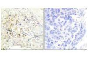 Immunohistochemistry analysis of paraffin-embedded human breast carcinoma tissue using HER3 antibody.