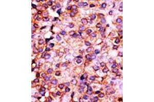 Formalin-fixed and paraffin-embedded human cancer tissue reacted with the primary antibody, which was peroxidase-conjugated to the secondary antibody, followed by AEC staining.