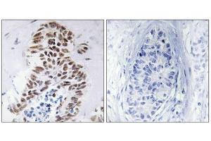 Immunohistochemistry analysis of paraffin-embedded human lung carcinoma tissue using DAPK3 (epitope around residue 265) antibody. (DAPK3 anticorps  (Thr265))