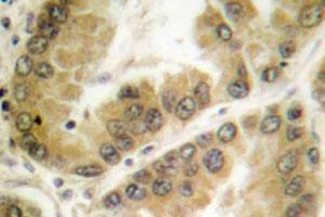 Immunohistochemical analysis of paraffin-embedded human lung cancer tissue using HDAC7 polyclonal antibody . (HDAC7 anticorps)