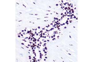 Immunohistochemistry of paraffin-embedded Human breast cancer using TriMethyl-Histone H3-K36 Rabbit pAb (ABIN3016038, ABIN3016039, ABIN3016040, ABIN1680217 and ABIN6219525) at dilution of 1:100 (40x lens). (Histone 3 anticorps  (H3K36me3))