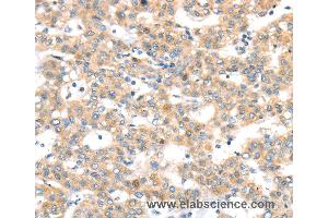Immunohistochemistry of Human thyroid cancer using RAB24 Polyclonal Antibody at dilution of 1:45 (RAB24 anticorps)