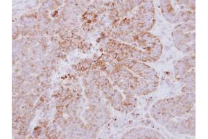 IHC-P Image Immunohistochemical analysis of paraffin-embedded human colon carcinoma, using GYG2, antibody at 1:500 dilution. (Glycogenin 2 anticorps  (N-Term))