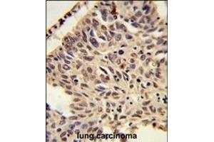 Formalin-fixed and paraffin-embedded human lung carcinoma reacted with PS Antibody (C-term), which was peroxidase-conjugated to the secondary antibody, followed by DAB staining.