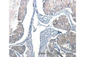 Immunohistochemistry of Human breast cancer using Ccl6 Polyclonal Antibody at dilution of 1:50
