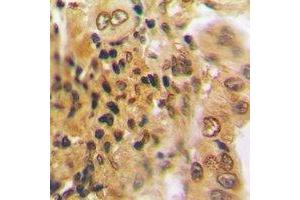 Immunohistochemical analysis of PSMD7 staining in human lung cancer formalin fixed paraffin embedded tissue section.