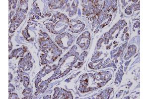 IHC-P Image Immunohistochemical analysis of paraffin-embedded human Thyroid gland tumor, using INPP1 , antibody at 1:100 dilution.