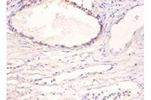 Immunohistochemistry of paraffin-embedded human prostate using BMP2 antibody at dilution of 1:100. (BMP2 anticorps)