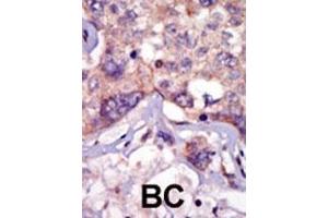 Formalin-fixed and paraffin-embedded human cancer tissue reacted with the primary antibody, which was peroxidase-conjugated to the secondary antibody, followed by AEC staining.