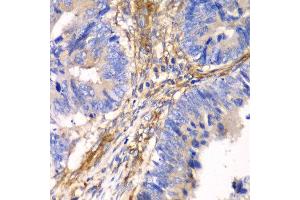 Immunohistochemistry of paraffin-embedded human colon carcinoma using HIP1 antibody at dilution of 1:100 (x40 lens). (HIP1 anticorps)