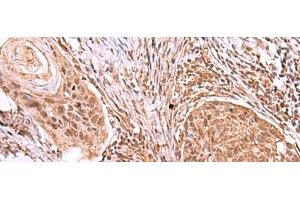 Immunohistochemistry of paraffin-embedded Human esophagus cancer tissue using IRX4 Polyclonal Antibody at dilution of 1:40(x200) (IRX4 anticorps)